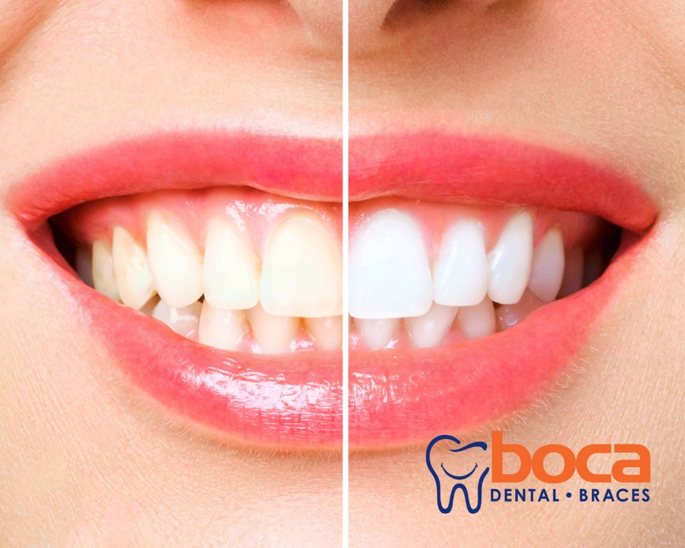 How Your Lifestyle Choices Can Impact the Results of Teeth Whitening Treatments